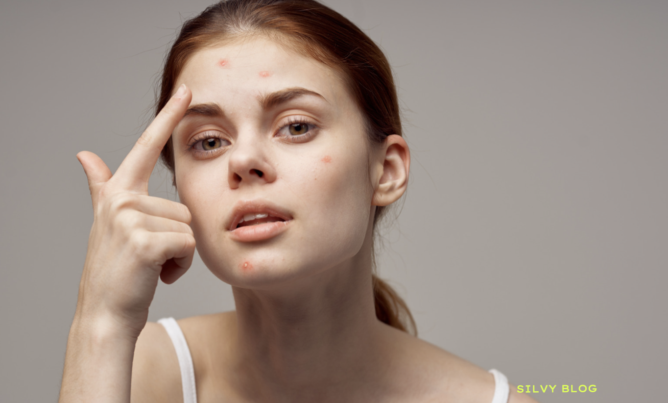 Can Products Cause Acne Causes Prevention Cure