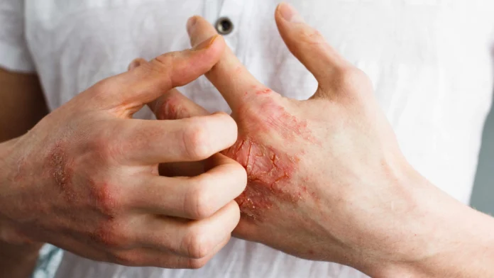 Home Remedies for Eczema: Calm and Soothe Your Skin