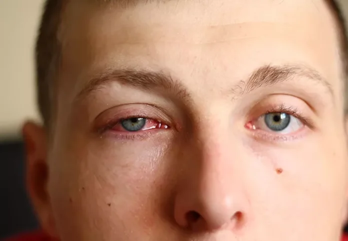 Effective Remedies for Pink Eye: Heal and Prevent Spread